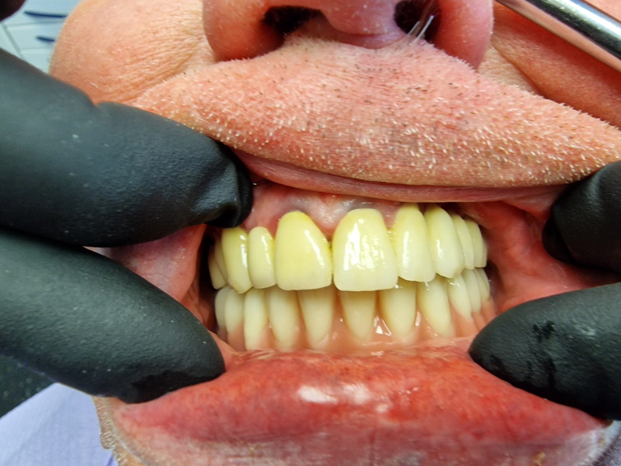 Zahnersatz auf Implantate - Bild 10