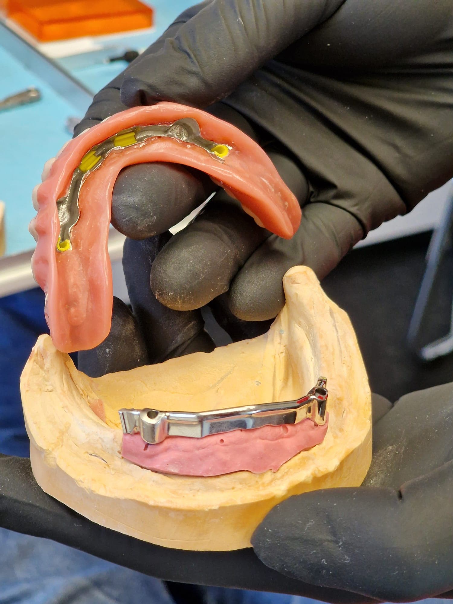 Zahnersatz auf Implantate - Bild 4