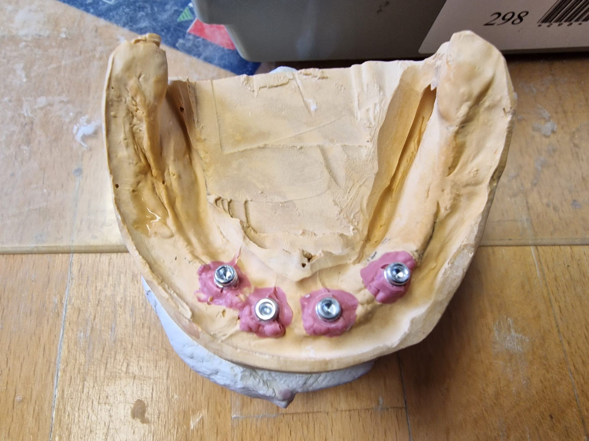 Zahnersatz auf Implantate - Bild 9