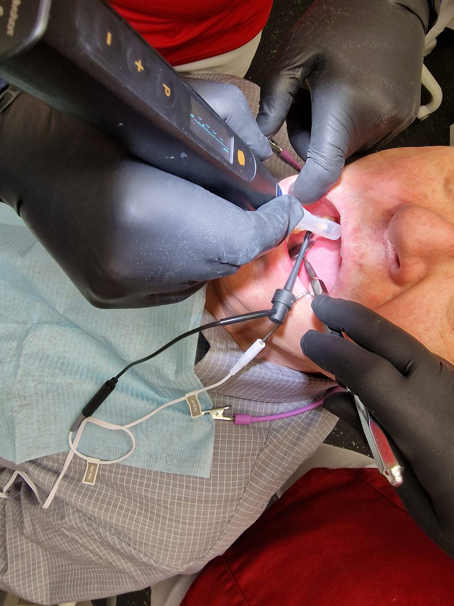 Wurzelkanal Behandlung