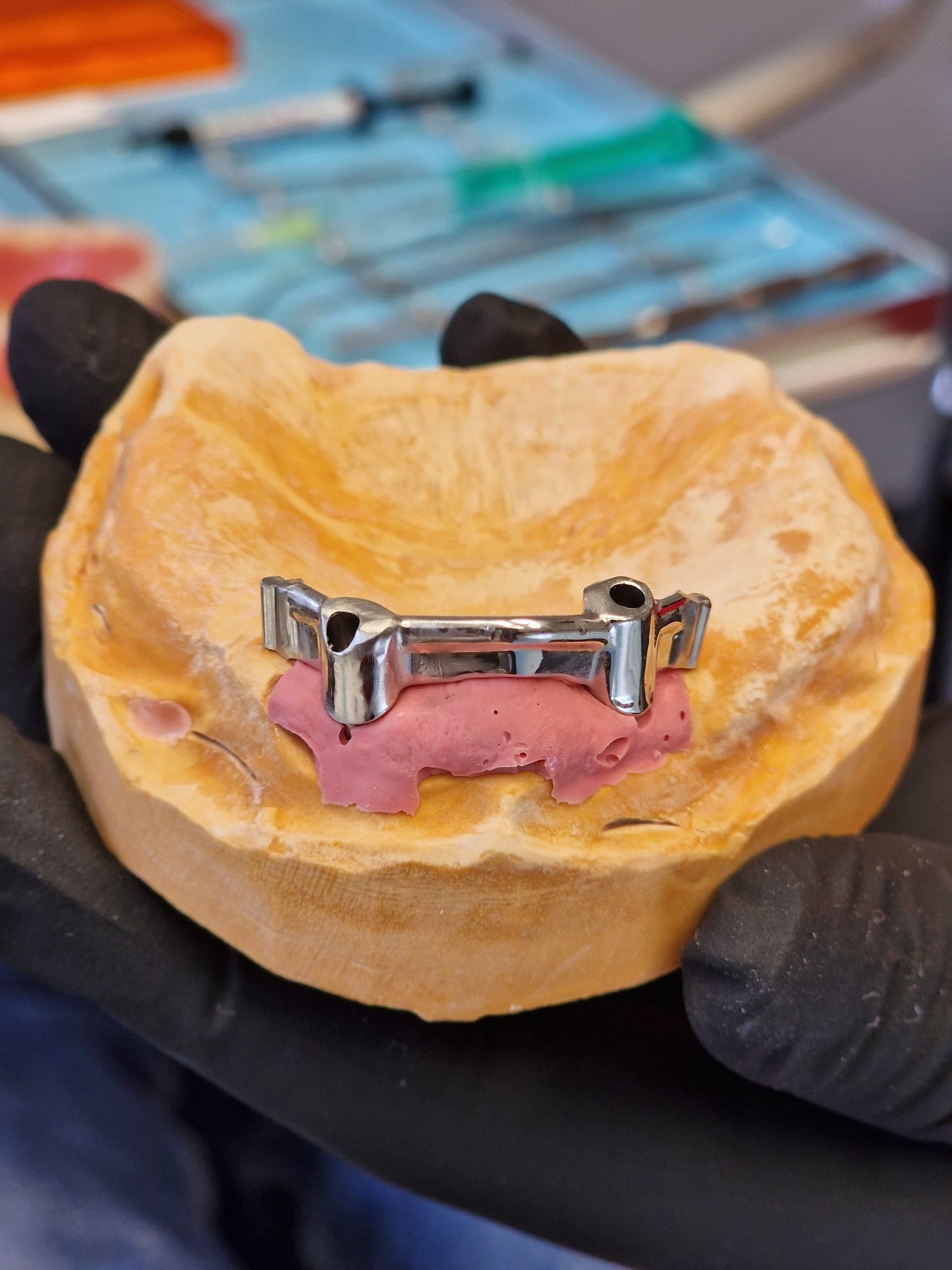 Zahnersatz auf Implantate