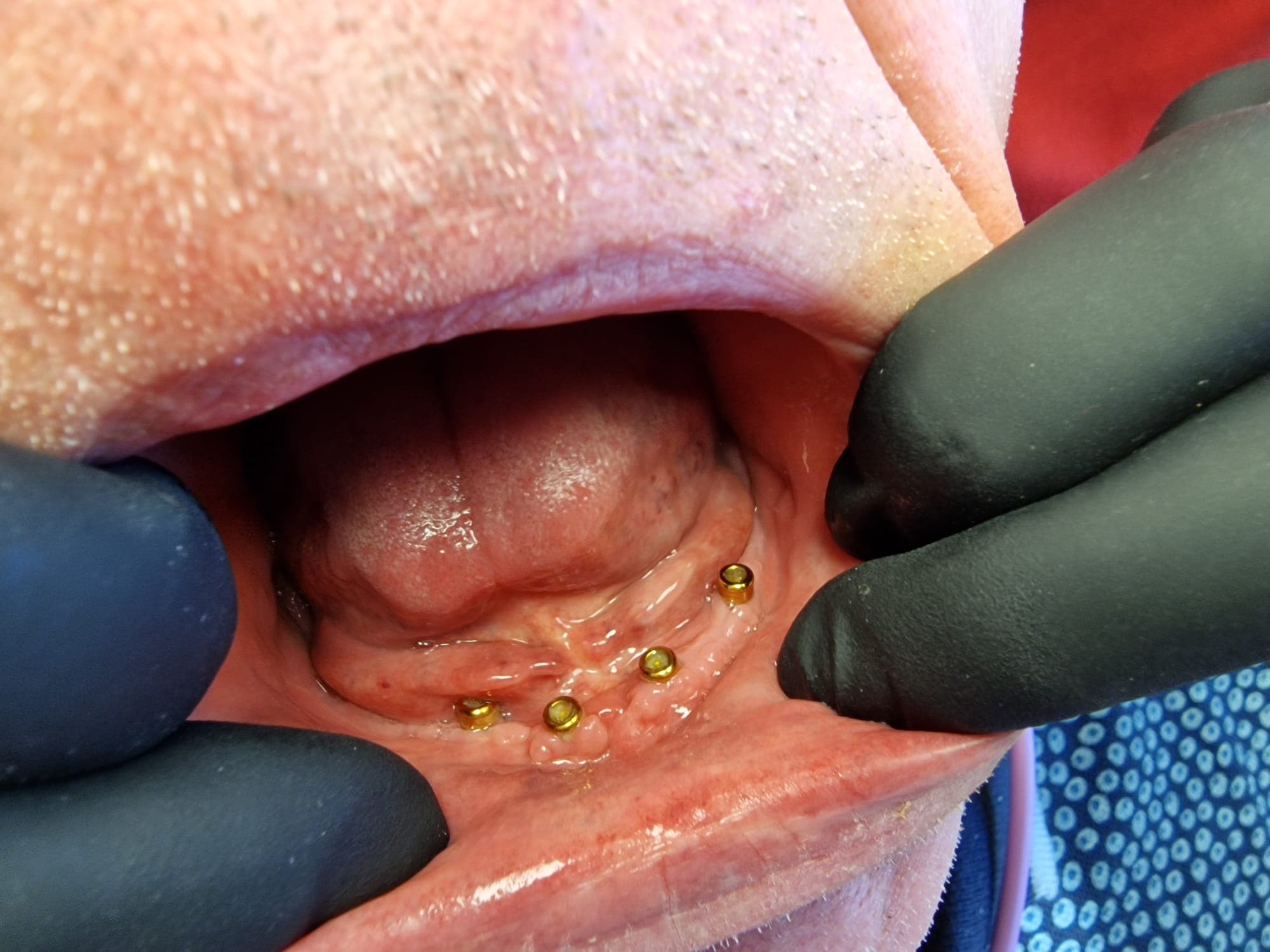 zahnersatz_auf_implantate 11.jpg