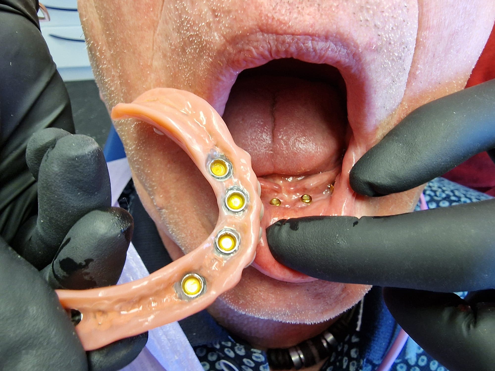zahnersatz_auf_implantate 12.jpg