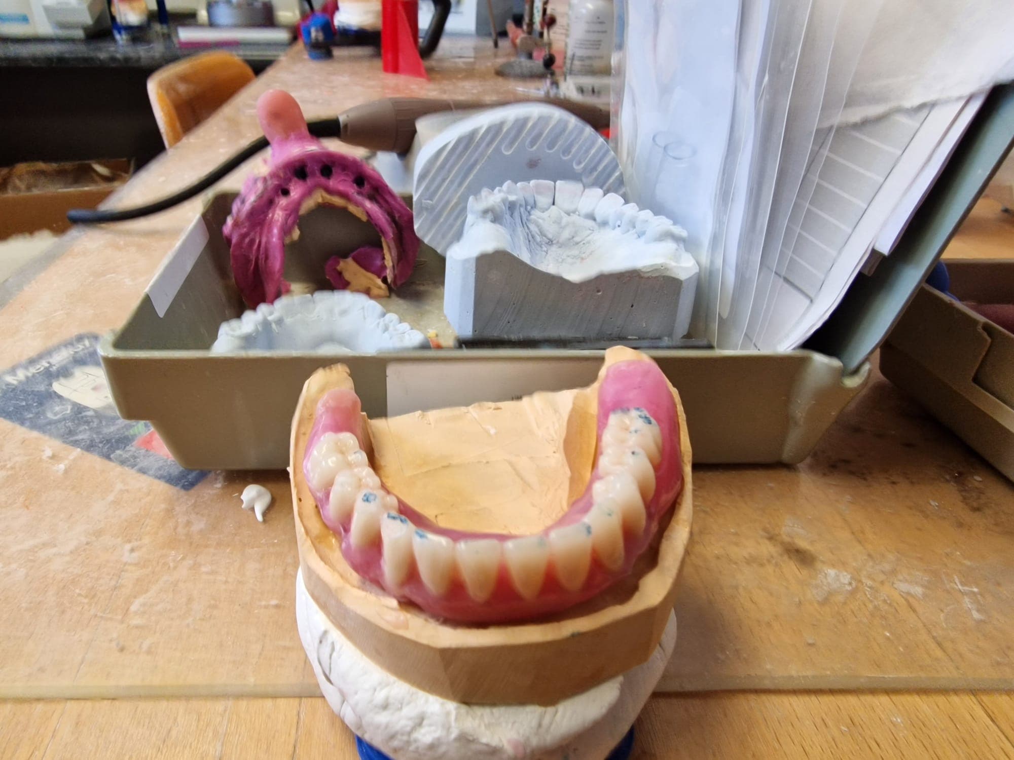 zahnersatz_auf_implantate 8.jpg