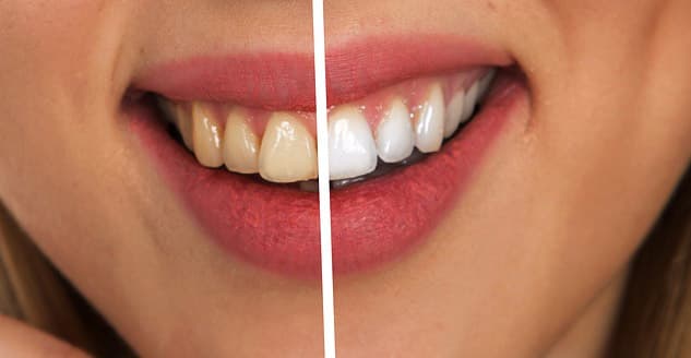 Bleaching_image