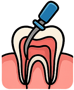 Wurzelkanalbehandlung
